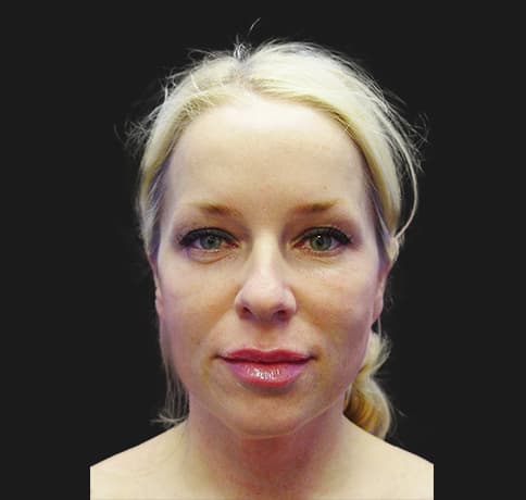 Case 6737 , Performed By Dr. Tehrani – angle 3 Before
