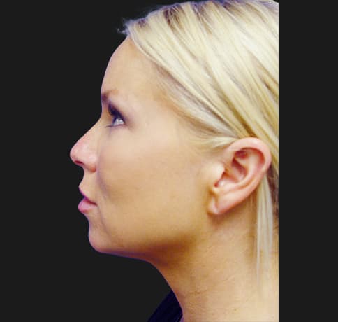 Case 6737 , Performed By Dr. Tehrani – angle 2 After