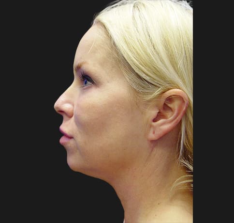 Case 6737 , Performed By Dr. Tehrani – angle 2 Before