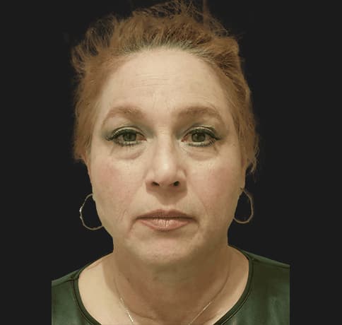 Case 36548, Performed By Dr. Tehrani – After