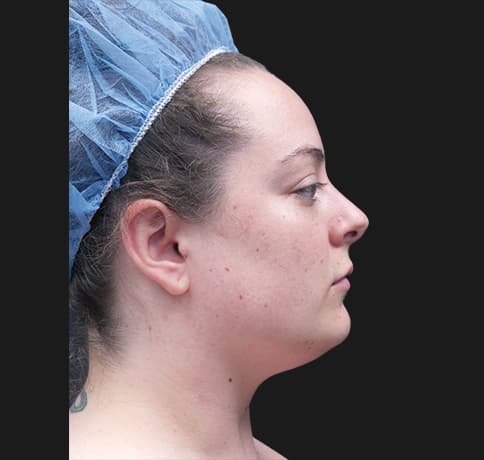 Case 50185, Performed By Dr. Tehrani – Before