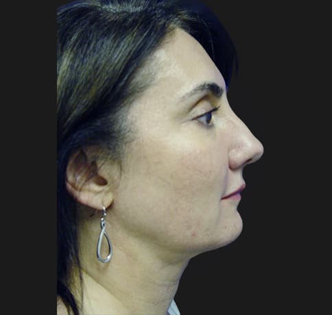 Case 8840 , Performed By Dr. Tehrani – After