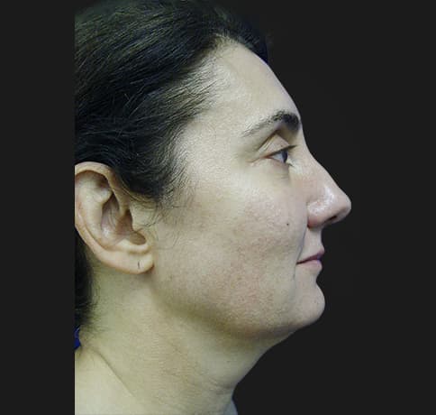 Case 8840 , Performed By Dr. Tehrani – Before