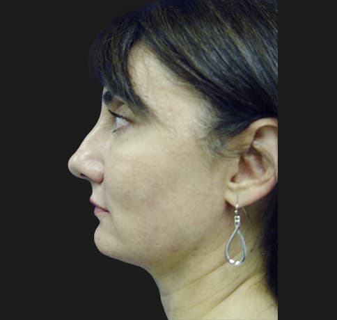 Case 8840 , Performed By Dr. Tehrani – After
