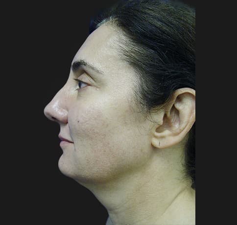 Case 8840 , Performed By Dr. Tehrani – Before