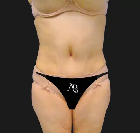 Case 13218, Performed By Dr. Tehrani – After