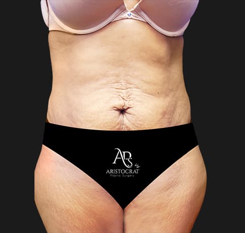 Case 22559, Performed By Dr. Tehrani – Before