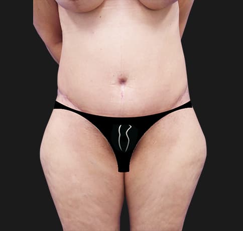 Case 23462, Performed By Dr. Tehrani – After