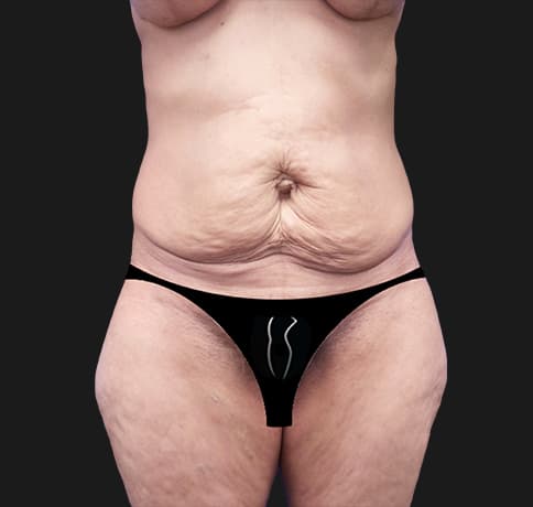 Case 23462, Performed By Dr. Tehrani – Before