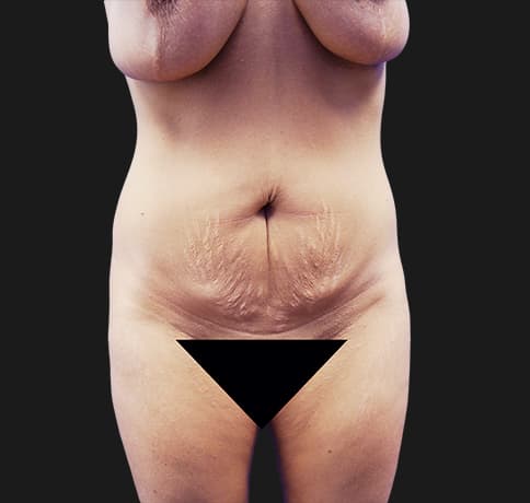 Case 20396, Performed By Dr. Tehrani – Before