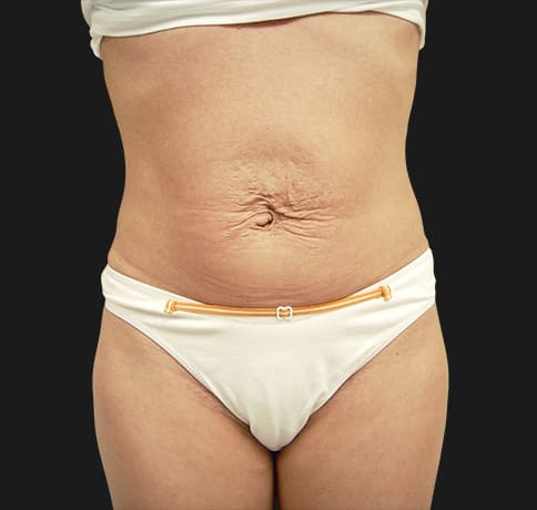 Case 5101, Performed By Dr. Tehrani – Before
