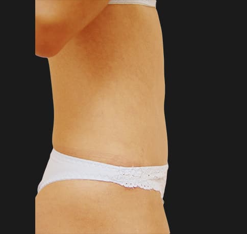 Case 5101, Performed By Dr. Tehrani – After