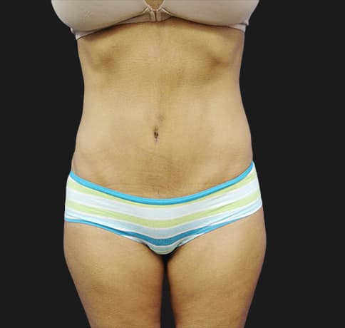 Case 10472, Performed By Dr. Tehrani – After