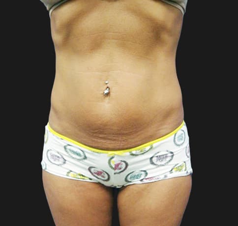 Case 10472, Performed By Dr. Tehrani – Before