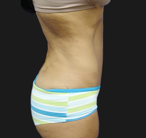 Case 10472, Performed By Dr. Tehrani – After