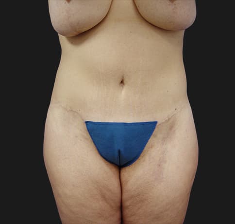 Case 6756 , Performed By Dr. Tehrani – After