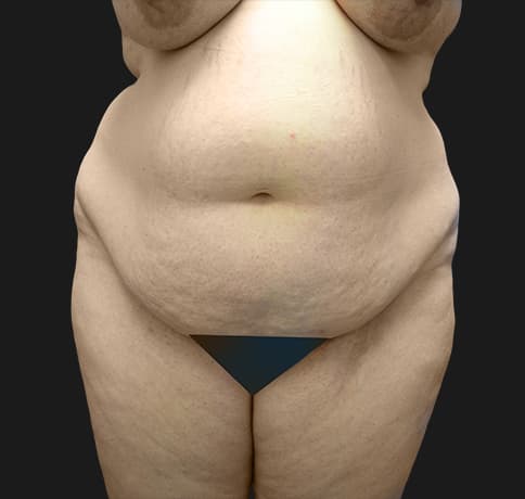 Case 6756 , Performed By Dr. Tehrani – Before
