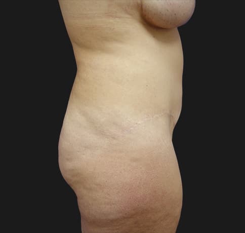 Case 6756 , Performed By Dr. Tehrani – After