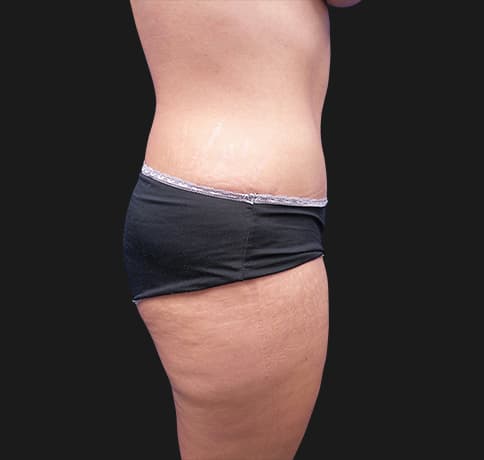 Case 41819, Performed By Dr. Tehrani – After