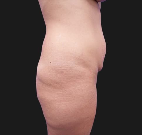 Case 41819, Performed By Dr. Tehrani – Before