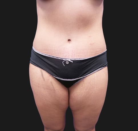 Case 41819, Performed By Dr. Tehrani – After