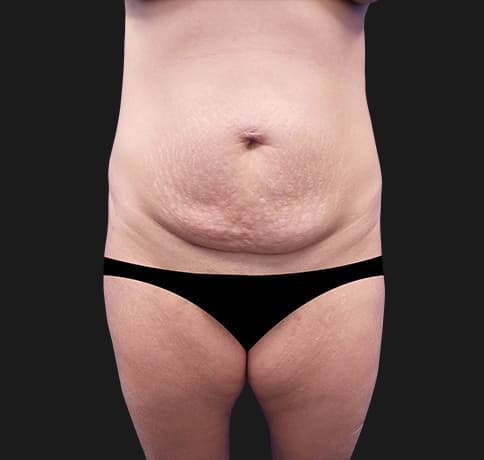 Case 41819, Performed By Dr. Tehrani – Before