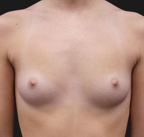 Case 32211 , Performed By Dr. Tehrani – Before