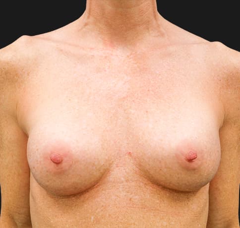 Case 35721, Performed By Dr. Tehrani – After