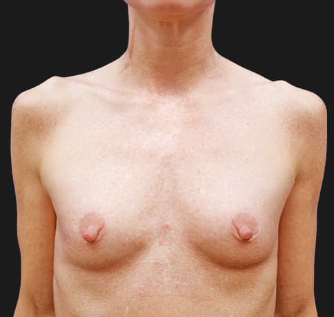 Case 35721, Performed By Dr. Tehrani – Before