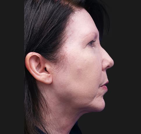 Case 33266 , Performed By Dr. Tehrani – After