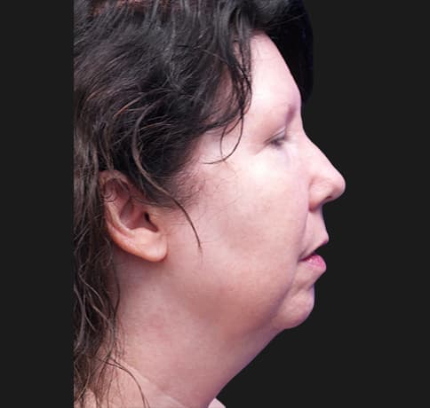 Case 33266 , Performed By Dr. Tehrani – Before