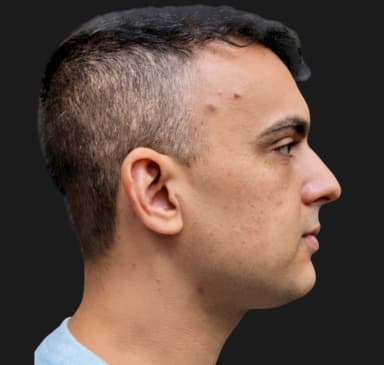 Case 33267 , Performed By Dr. Tehrani – After