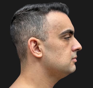 Case 33267 , Performed By Dr. Tehrani – Before