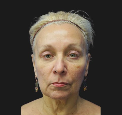 Case 28242 , Performed By Dr. Tehrani – After