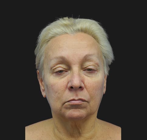 Case 28242 , Performed By Dr. Tehrani – Before