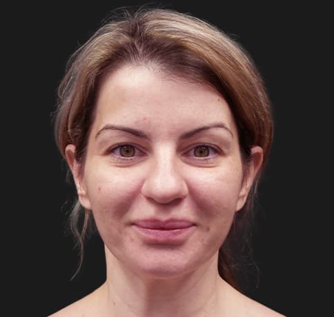 Case 47824, Performed By Dr. Tehrani – Before