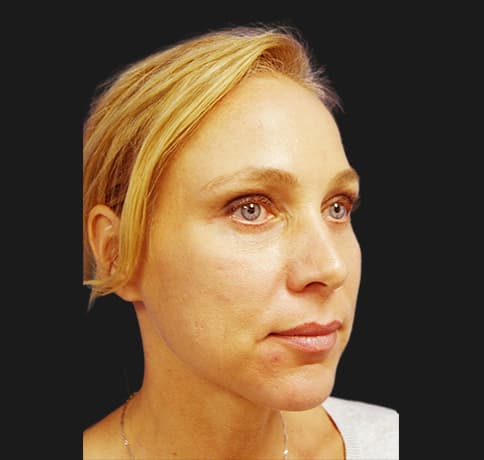 Case 9982 , Performed By Dr. Tehrani – After