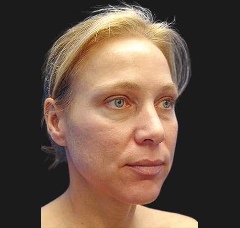 Case 9982 , Performed By Dr. Tehrani – Before