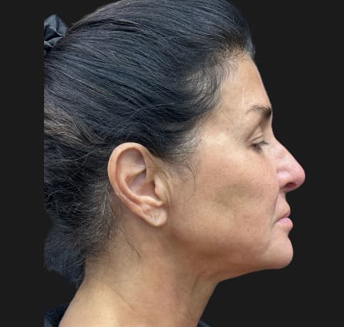 Case 59621, Performed By Dr. Tehrani – After