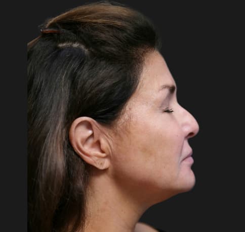 Case 59621, Performed By Dr. Tehrani – Before