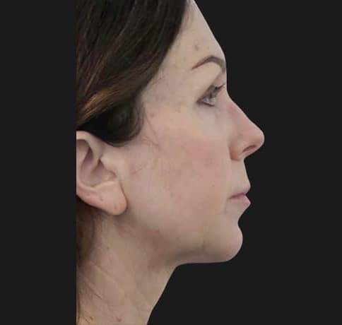 Case 53892, Performed By Dr. Tehrani – After