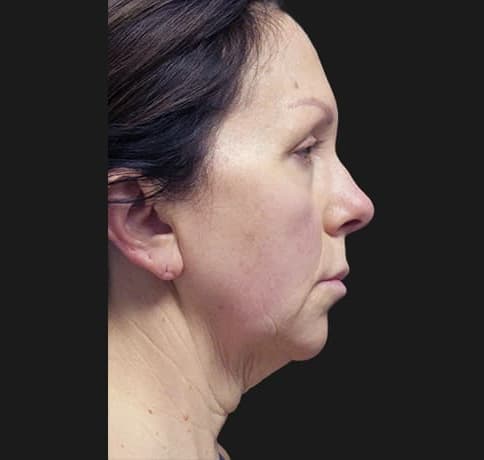 Case 53892, Performed By Dr. Tehrani – Before