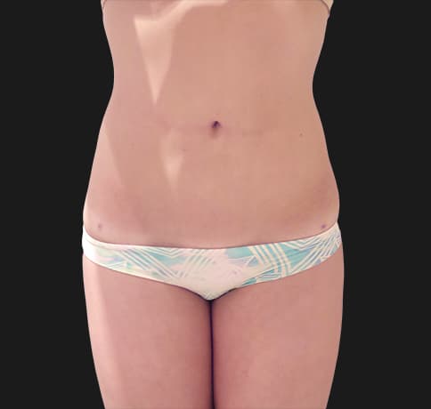 Case 37388, Performed By Dr. Tehrani – After