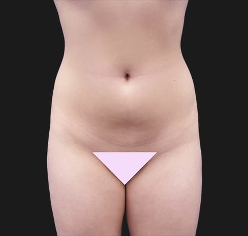 Case 37388, Performed By Dr. Tehrani – Before