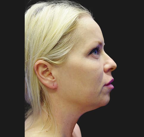 Case 6737 , Performed By Dr. Tehrani – Before