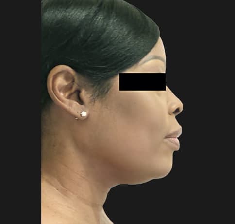 Case 7894 , Performed By Dr. Tehrani – Before