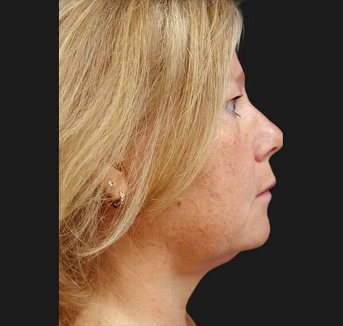 Case 6514 , Performed By Dr. Tehrani – After