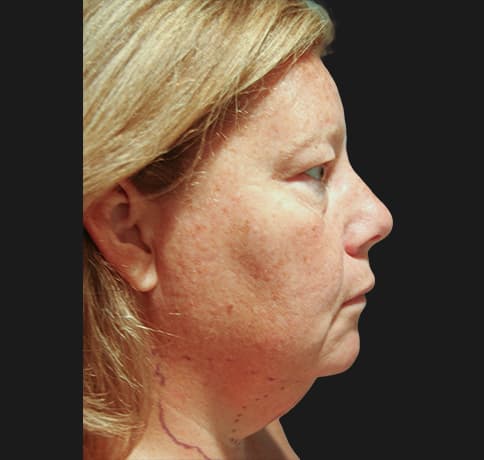 Case 6514 , Performed By Dr. Tehrani – Before
