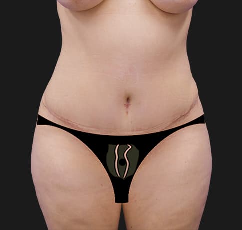 Case 44000, Performed By Dr. Tehrani – After