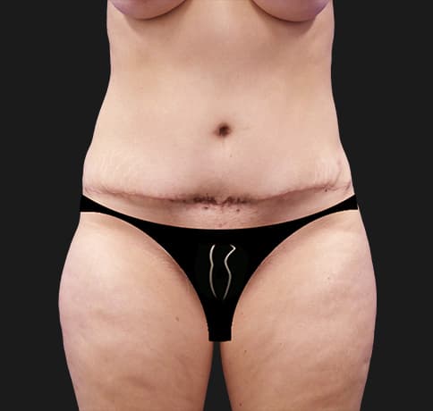 Case 44000, Performed By Dr. Tehrani – Before